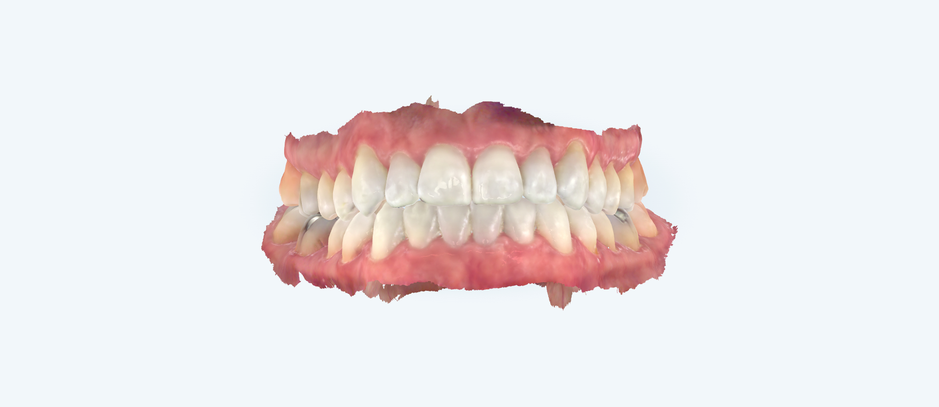Openbite treatment comparison case 2 after